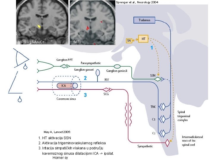 Sprenger et al. , Neurology 2004 MRS – ↓NAA/Cr f. MRI 1 2 3