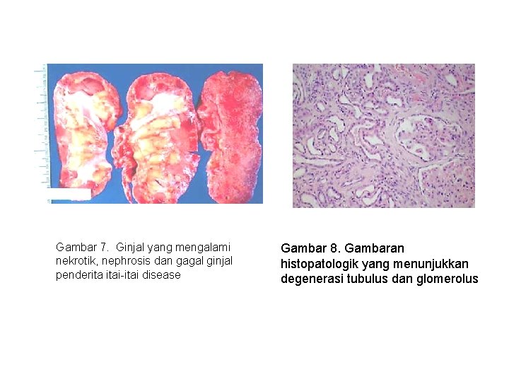 Gambar 7. Ginjal yang mengalami nekrotik, nephrosis dan gagal ginjal penderita itai-itai disease Gambar