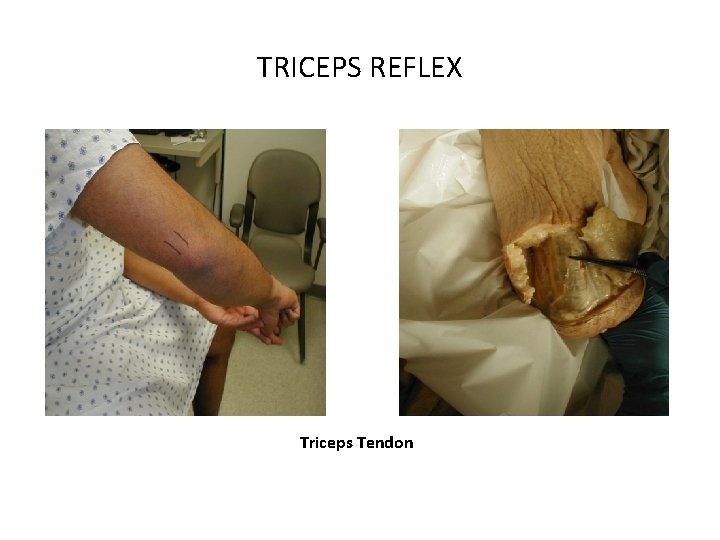 TRICEPS REFLEX Triceps Tendon 