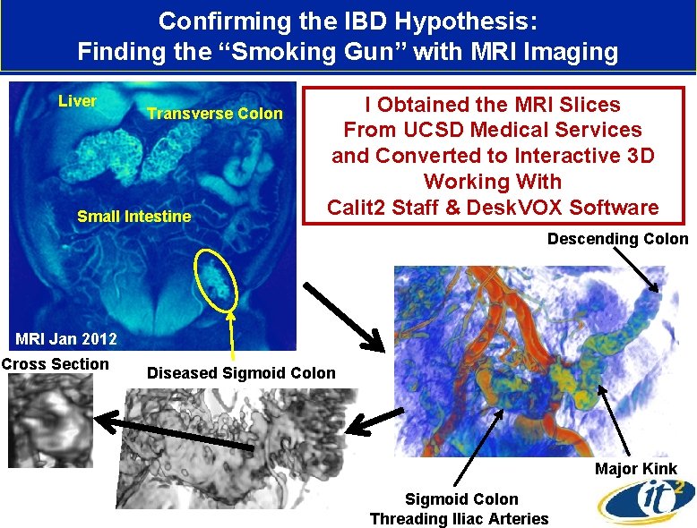 Confirming the IBD Hypothesis: Finding the “Smoking Gun” with MRI Imaging Liver Transverse Colon