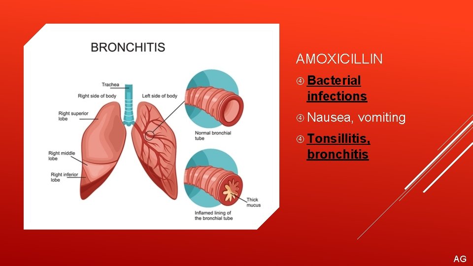 AMOXICILLIN Bacterial infections Nausea, vomiting Tonsillitis, bronchitis AG 