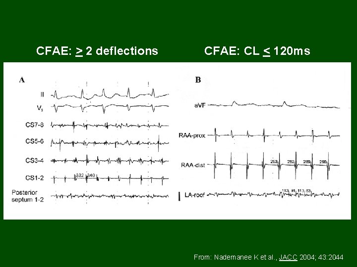 CFAE: > 2 deflections CFAE: CL < 120 ms From: Nademanee K et al.