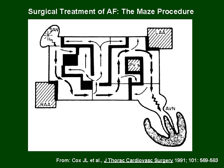 Surgical Treatment of AF: The Maze Procedure From: Cox JL et al. , J