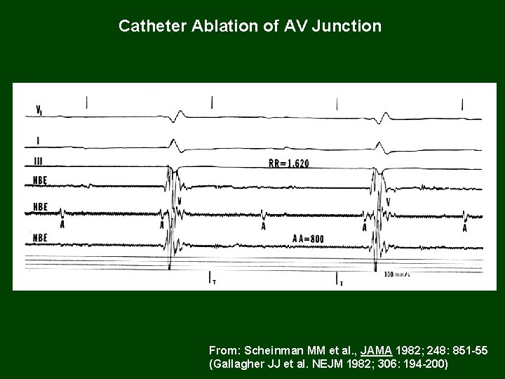 Catheter Ablation of AV Junction From: Scheinman MM et al. , JAMA 1982; 248: