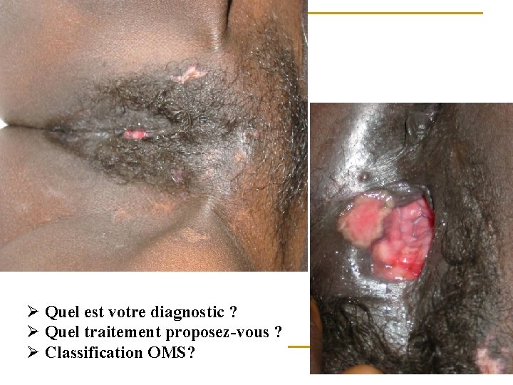 Ø Quel est votre diagnostic ? Ø Quel traitement proposez-vous ? Ø Classification OMS?