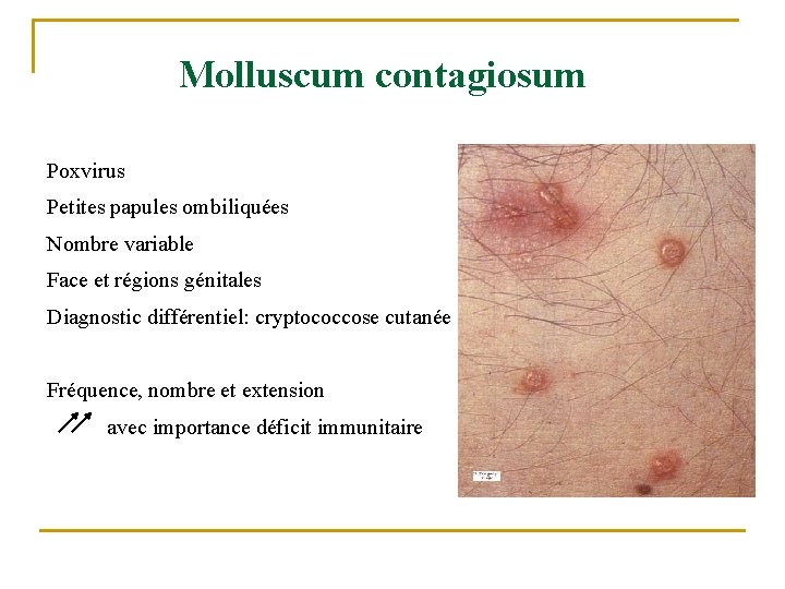 Molluscum contagiosum Poxvirus Petites papules ombiliquées Nombre variable Face et régions génitales Diagnostic différentiel: