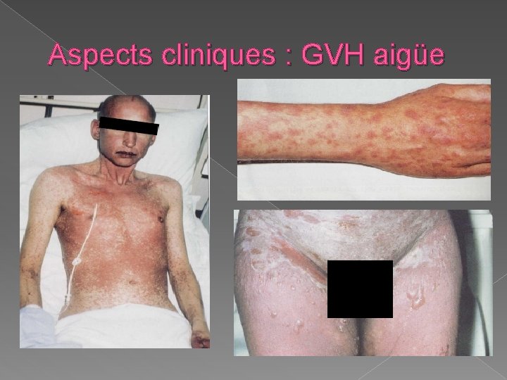 Aspects cliniques : GVH aigüe 