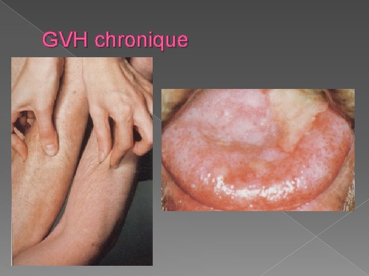 GVH chronique 