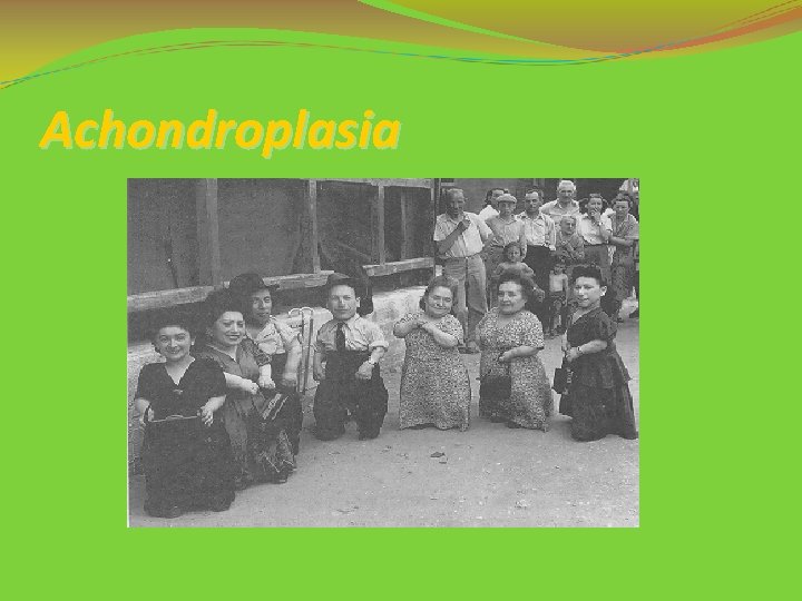 Achondroplasia 