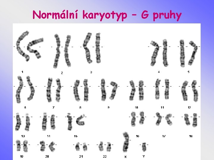 Normální karyotyp – G pruhy 