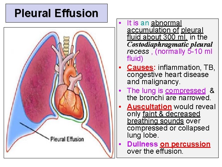 Pleural Effusion • It is an abnormal accumulation of pleural fluid about 300 ml,