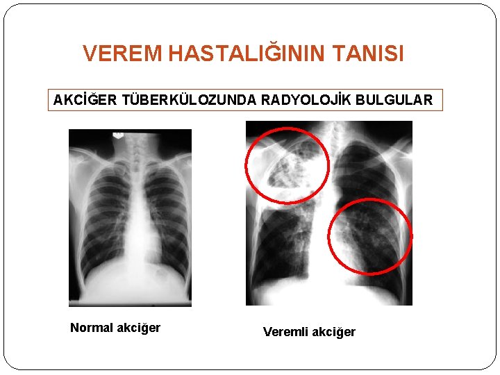 VEREM HASTALIĞININ TANISI AKCİĞER TÜBERKÜLOZUNDA RADYOLOJİK BULGULAR Normal akciğer Veremli akciğer 