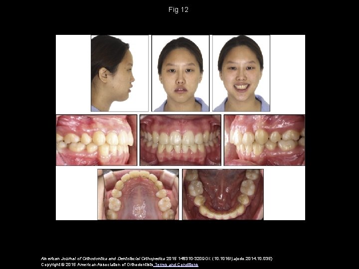 Fig 12 American Journal of Orthodontics and Dentofacial Orthopedics 2015 148310 -320 DOI: (10.