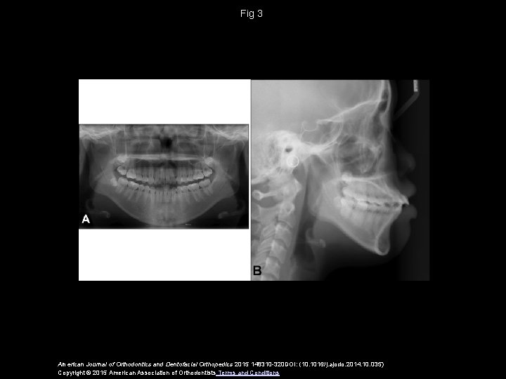 Fig 3 American Journal of Orthodontics and Dentofacial Orthopedics 2015 148310 -320 DOI: (10.