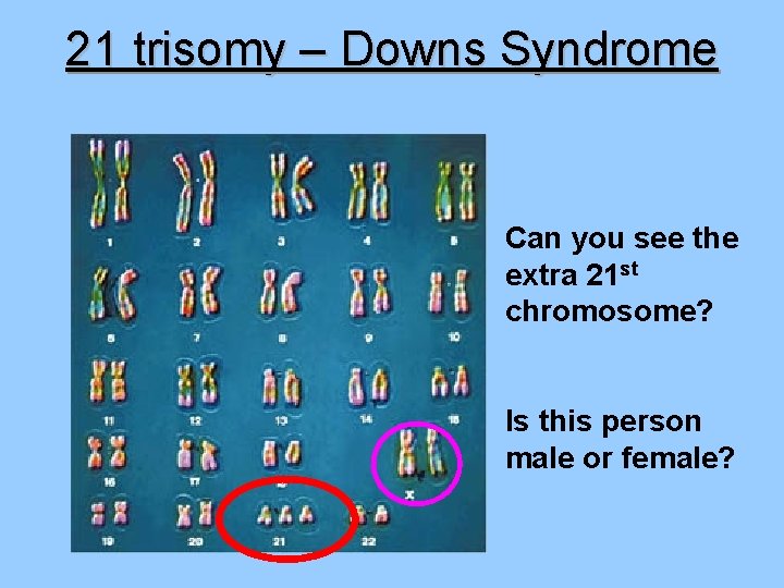 21 trisomy – Downs Syndrome Can you see the extra 21 st chromosome? Is