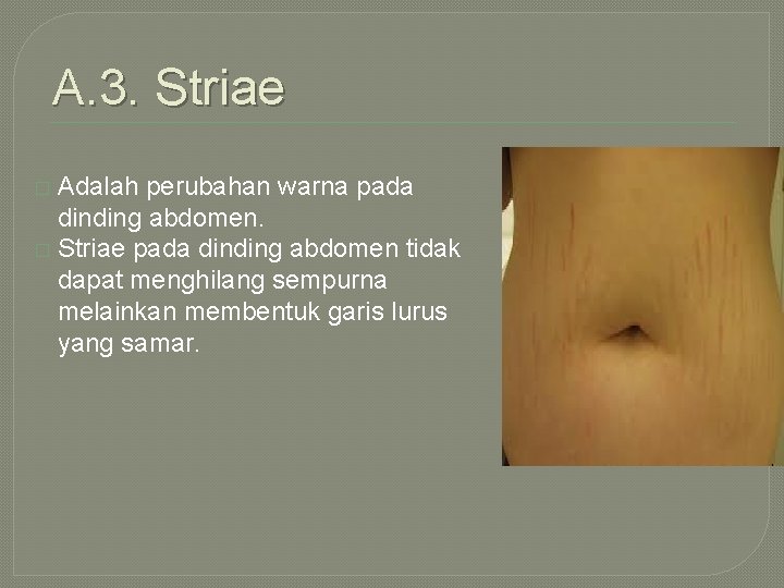 A. 3. Striae Adalah perubahan warna pada dinding abdomen. � Striae pada dinding abdomen