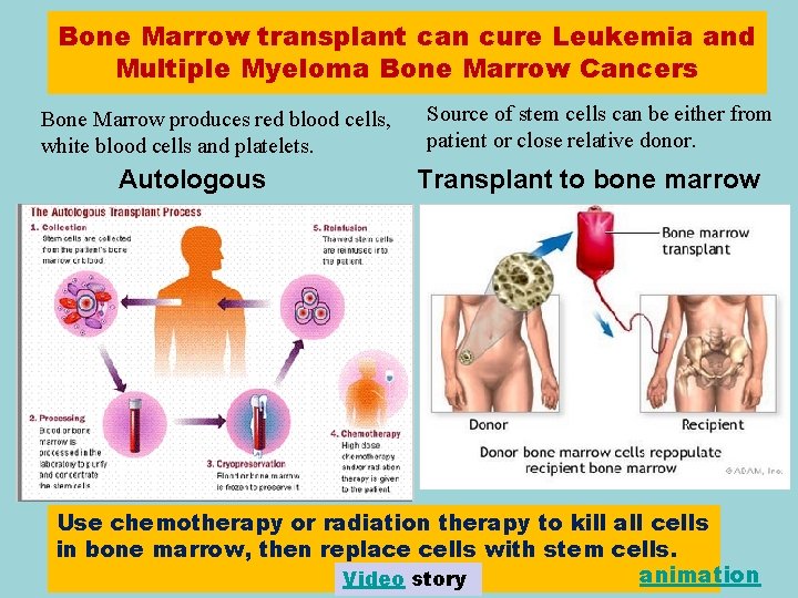 Bone Marrow transplant can cure Leukemia and Multiple Myeloma Bone Marrow Cancers Bone Marrow