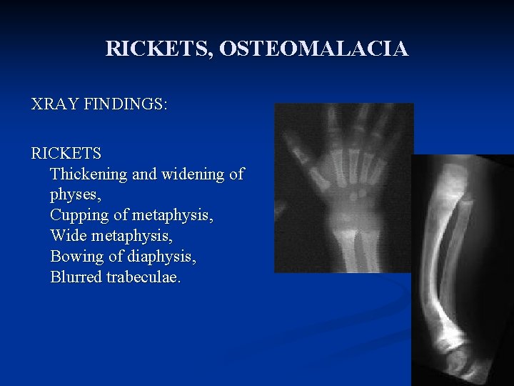 RICKETS, OSTEOMALACIA XRAY FINDINGS: RICKETS Thickening and widening of physes, Cupping of metaphysis, Wide