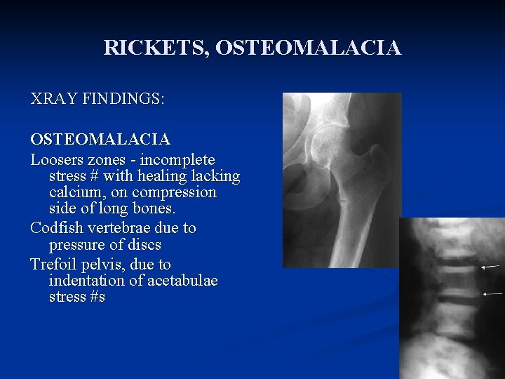 RICKETS, OSTEOMALACIA XRAY FINDINGS: OSTEOMALACIA Loosers zones - incomplete stress # with healing lacking