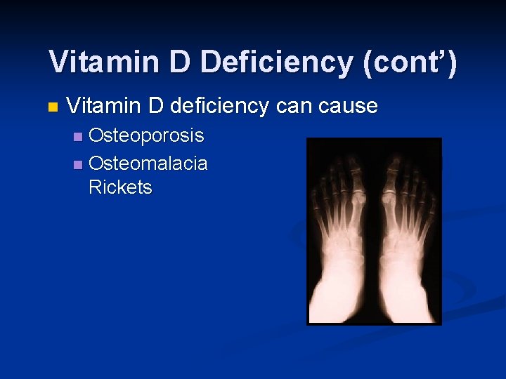 Vitamin D Deficiency (cont’) n Vitamin D deficiency can cause Osteoporosis n Osteomalacia and