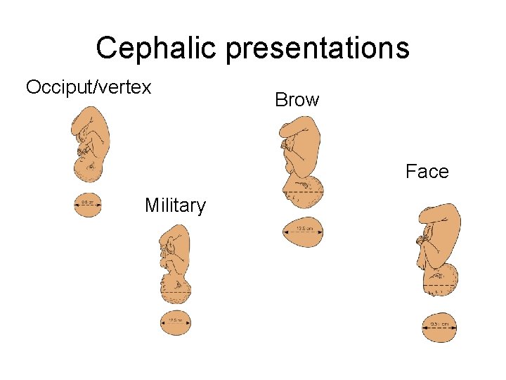 Cephalic presentations Occiput/vertex Brow Face Military 