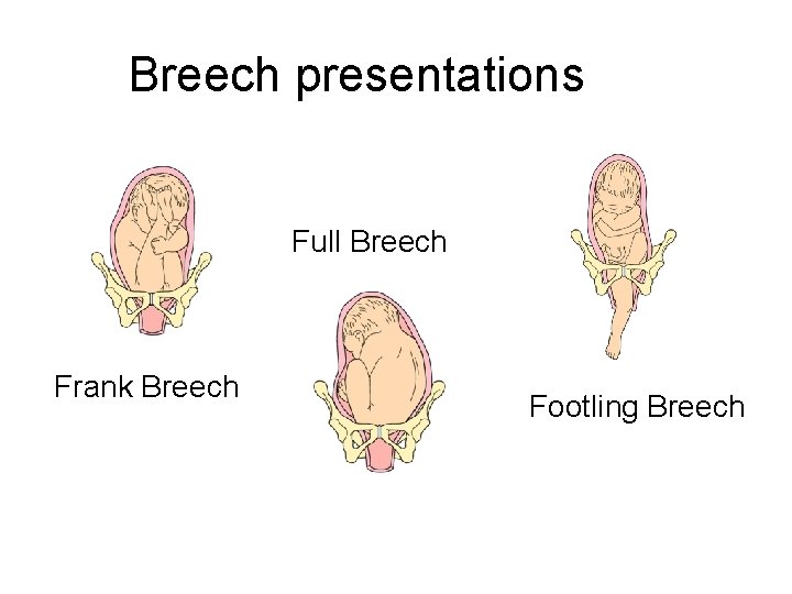Breech presentations Full Breech Frank Breech Footling Breech 