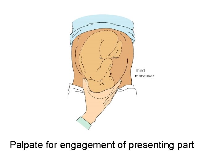 Palpate for engagement of presenting part 