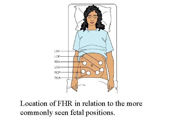 Location of FHR in relation to the more commonly seen fetal positions. 
