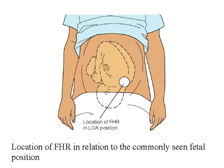 Location of FHR in relation to the commonly seen fetal position 