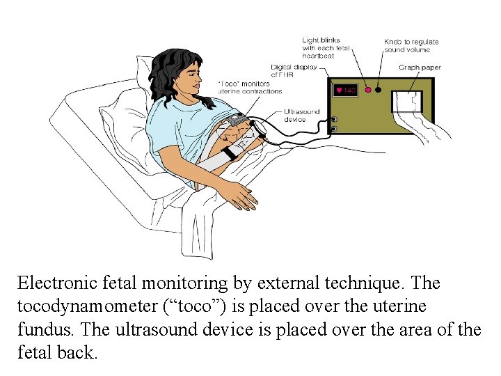 Electronic fetal monitoring by external technique. The tocodynamometer (“toco”) is placed over the uterine