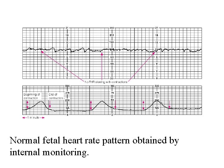 Normal fetal heart rate pattern obtained by internal monitoring. 
