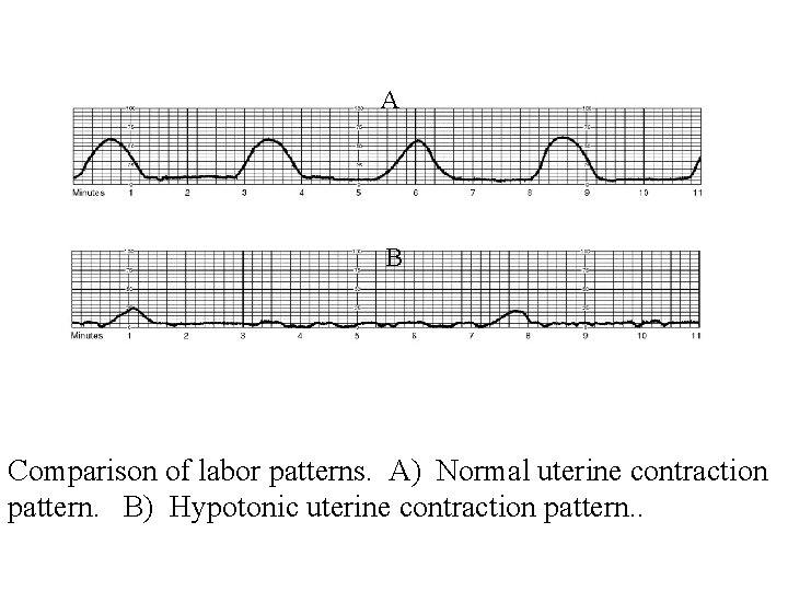 A B Comparison of labor patterns. A) Normal uterine contraction pattern. B) Hypotonic uterine