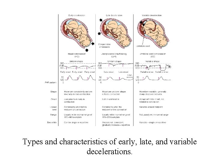 Types and characteristics of early, late, and variable decelerations. 