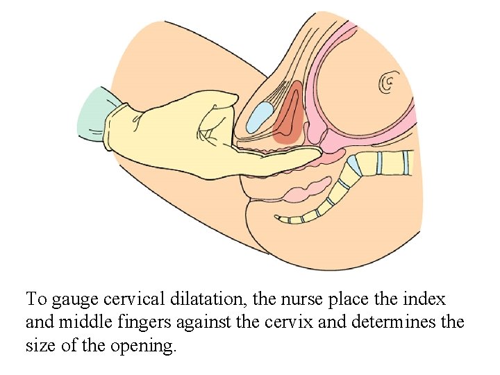 To gauge cervical dilatation, the nurse place the index and middle fingers against the