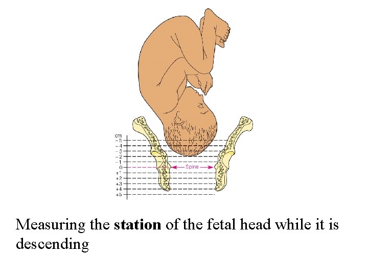 Measuring the station of the fetal head while it is descending 