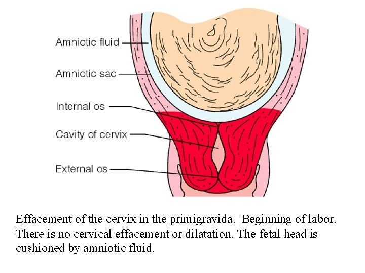 Effacement of the cervix in the primigravida. Beginning of labor. There is no cervical