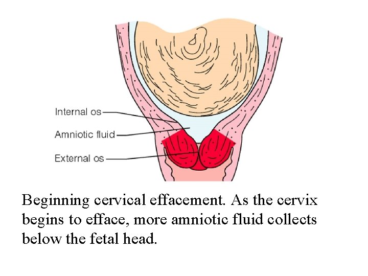 Beginning cervical effacement. As the cervix begins to efface, more amniotic fluid collects below