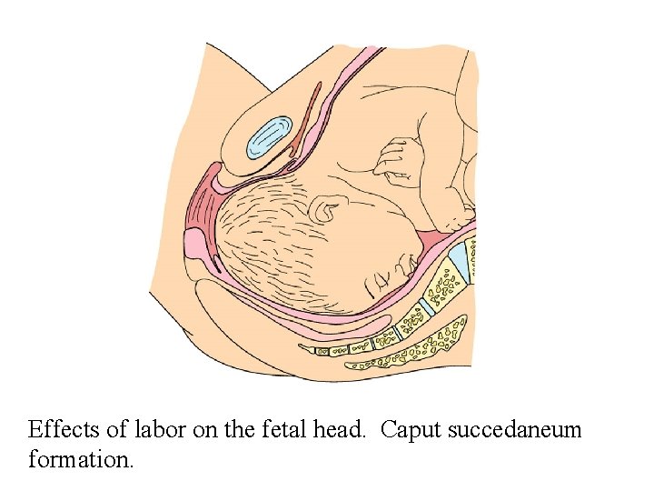 Effects of labor on the fetal head. Caput succedaneum formation. 