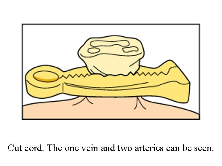 Cut cord. The one vein and two arteries can be seen. 