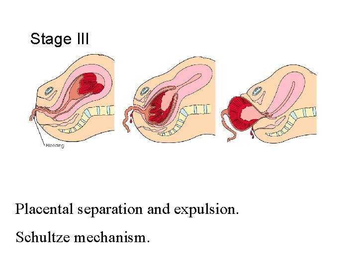 Stage III Placental separation and expulsion. Schultze mechanism. 