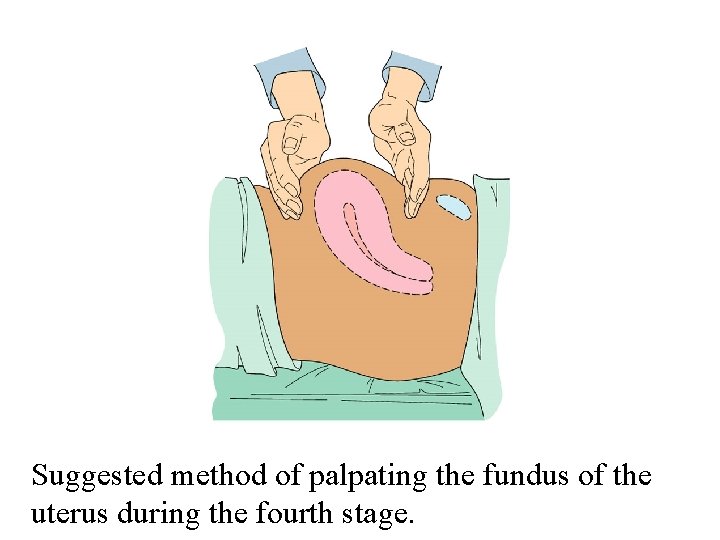 Suggested method of palpating the fundus of the uterus during the fourth stage. 