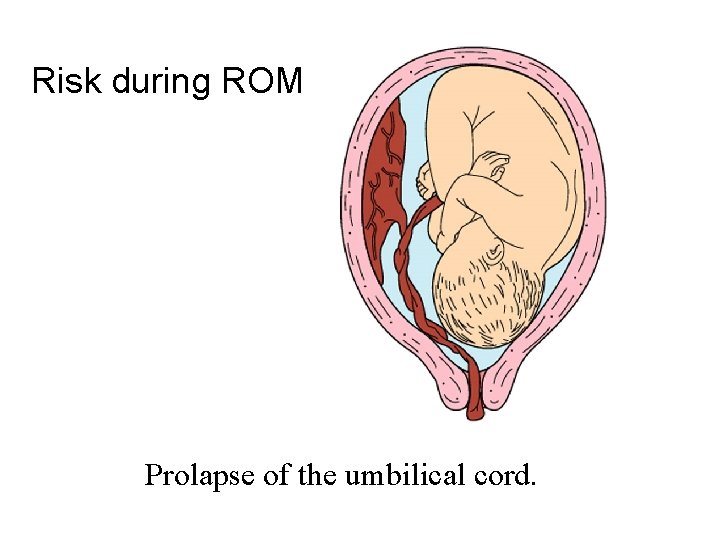 Risk during ROM Prolapse of the umbilical cord. 