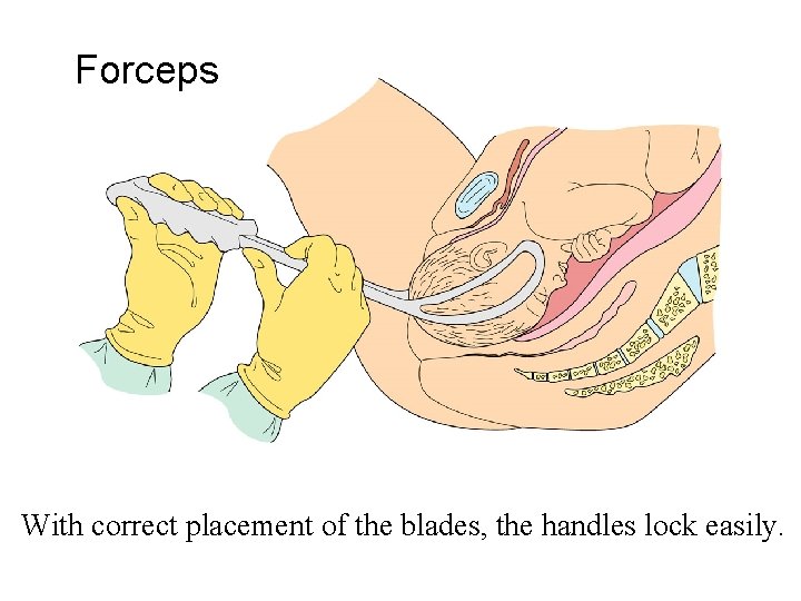 Forceps With correct placement of the blades, the handles lock easily. 