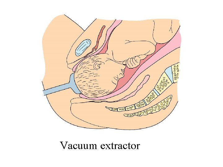 Vacuum extractor 