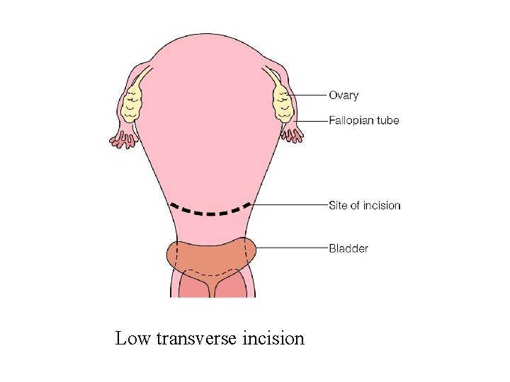 Low transverse incision 