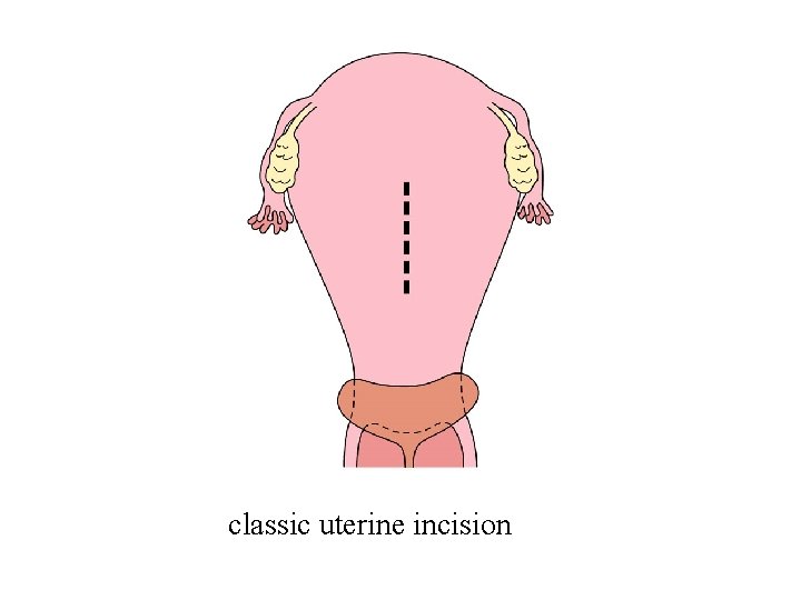 classic uterine incision 
