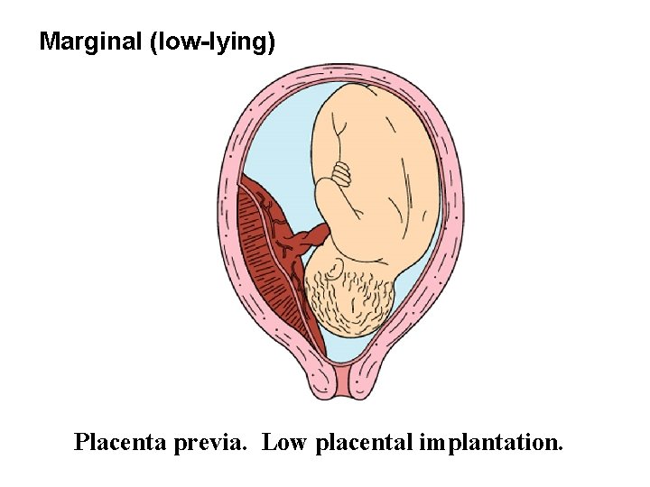 Marginal (low-lying) Placenta previa. Low placental implantation. 