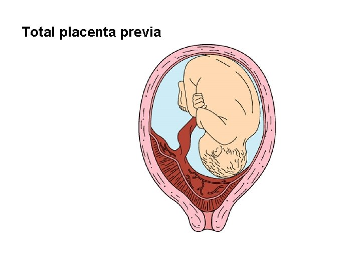 Total placenta previa 