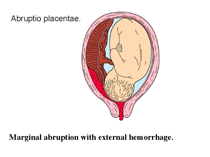 Abruptio placentae. Marginal abruption with external hemorrhage. 