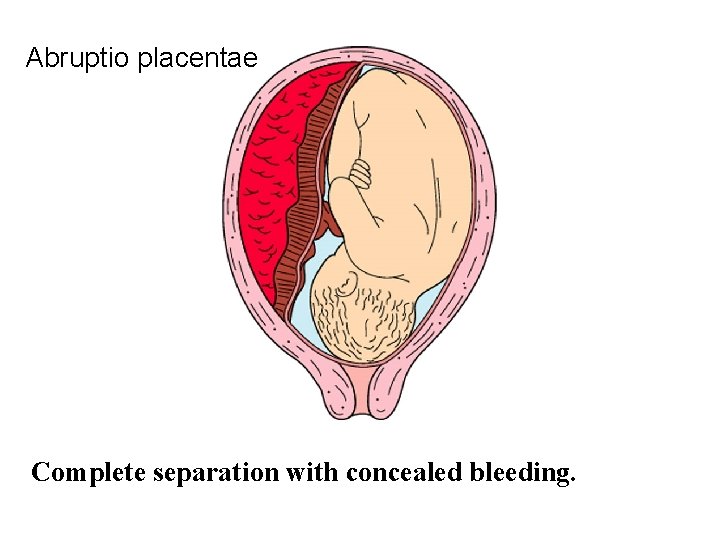 Abruptio placentae Complete separation with concealed bleeding. 